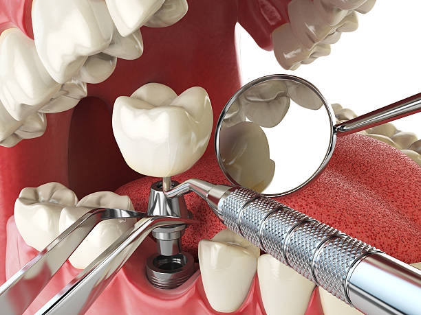 Best Emergency Dentist for Lost Fillings or Crowns in Smyrna, GA